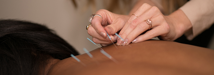 Acupuncture Redondo Beach CA Acupuncture Acupuncture Redondo Beach CA Acupuncture